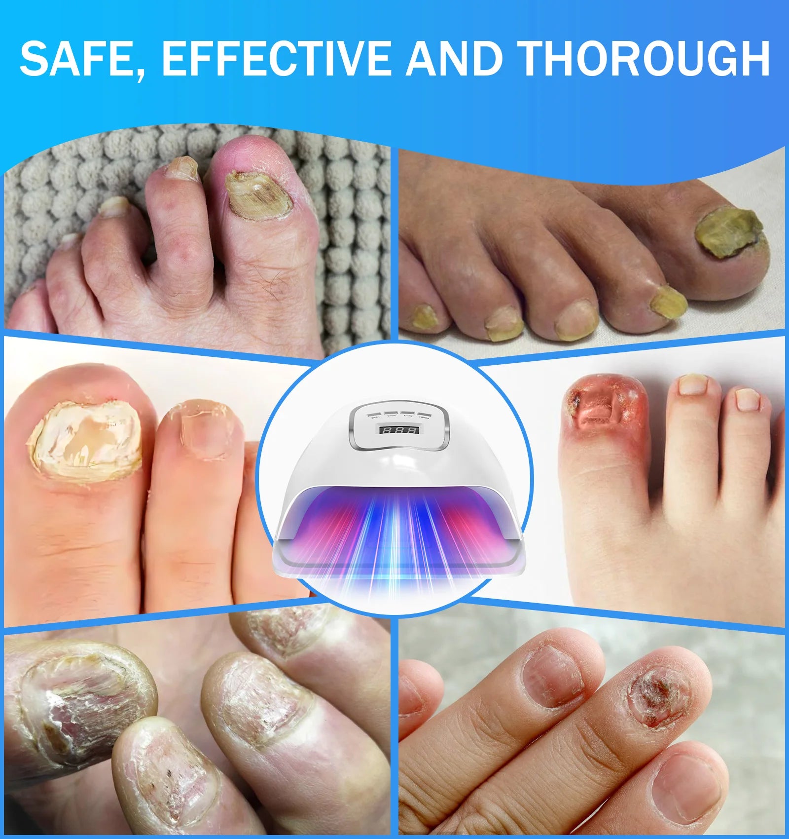 Nail Laser Fungus
